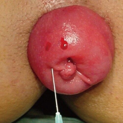 Free porn pics of Prolapse...turn on or off? 14 of 22 pics