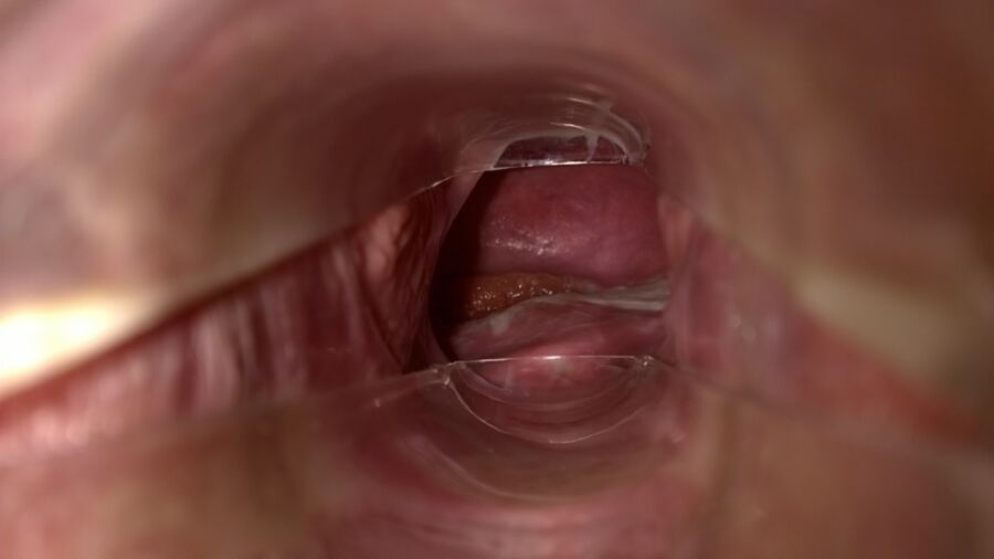 Pregnant Cervix Dilated Fetish Porn Pic