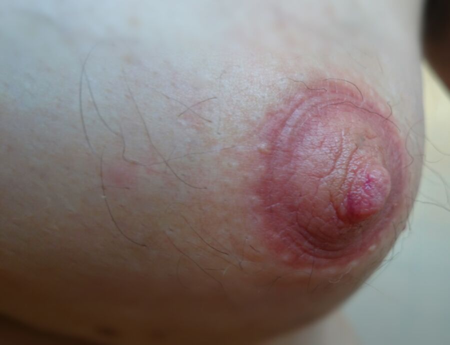 Free porn pics of My nipples after being strongly sucked into a pump. 2 of 14 pics