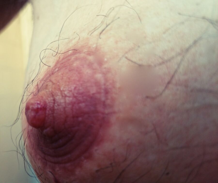 Free porn pics of My nipples after being strongly sucked into a pump. 8 of 14 pics
