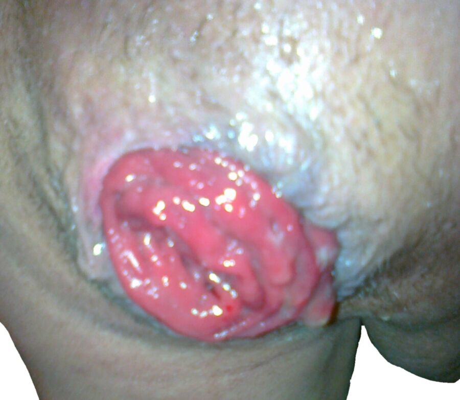 Free porn pics of Large Plugg (deep penetration) and Prolapse !!!! 23 of 24 pics
