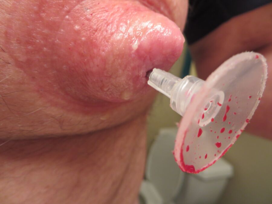Free porn pics of needle vacuumed into nipple 15 of 16 pics