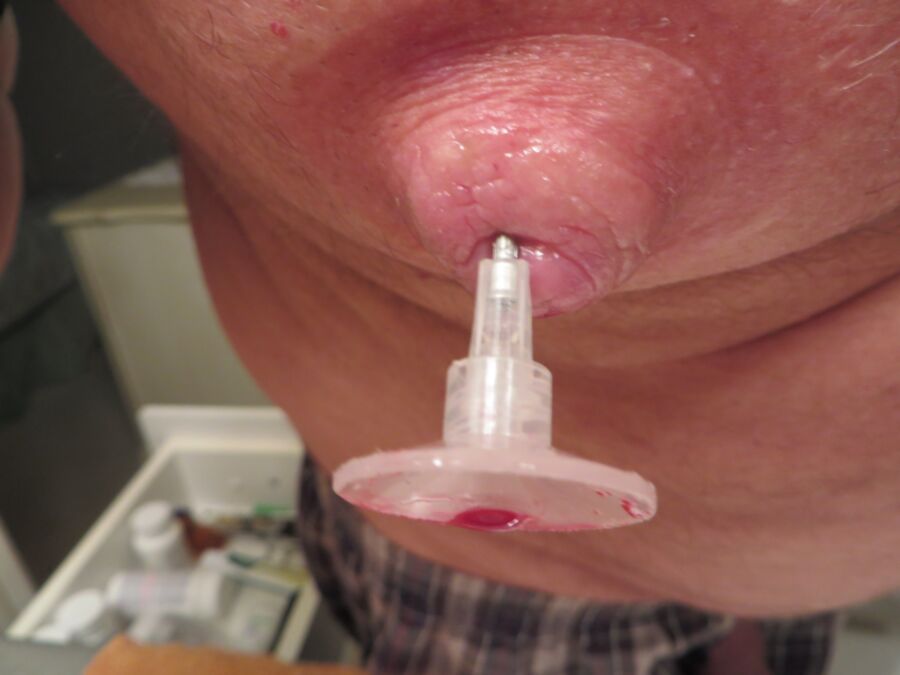 Free porn pics of needle vacuumed into nipple 5 of 16 pics