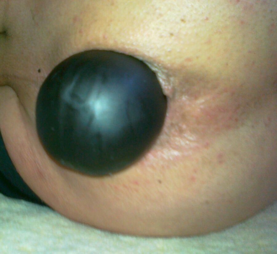 Free porn pics of Triple Balls Deep Penetrated My Ass( Prolapse !!!!) 2 of 31 pics