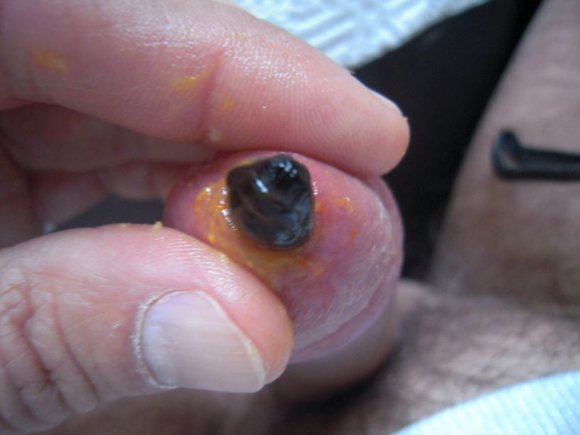 Free porn pics of More slugs in my pee hole 9 of 11 pics