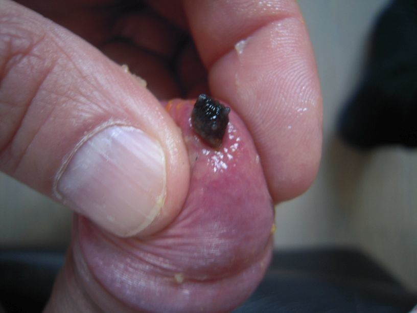 Free porn pics of More slugs in my pee hole 5 of 11 pics