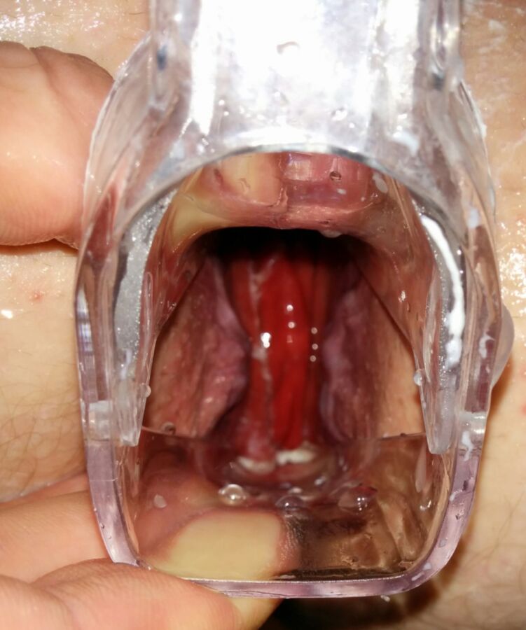 Free porn pics of Anal speculum again 6 of 10 pics