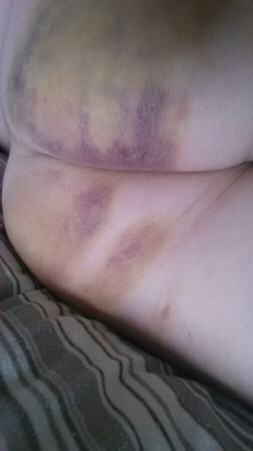 Free porn pics of My cheating wife Karen with marks and bruises from her Master 8 of 13 pics