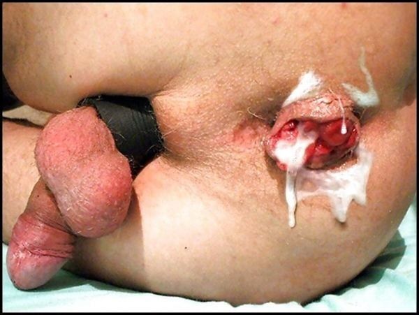 Free porn pics of Prolapse ten turn on or off? 3 of 91 pics
