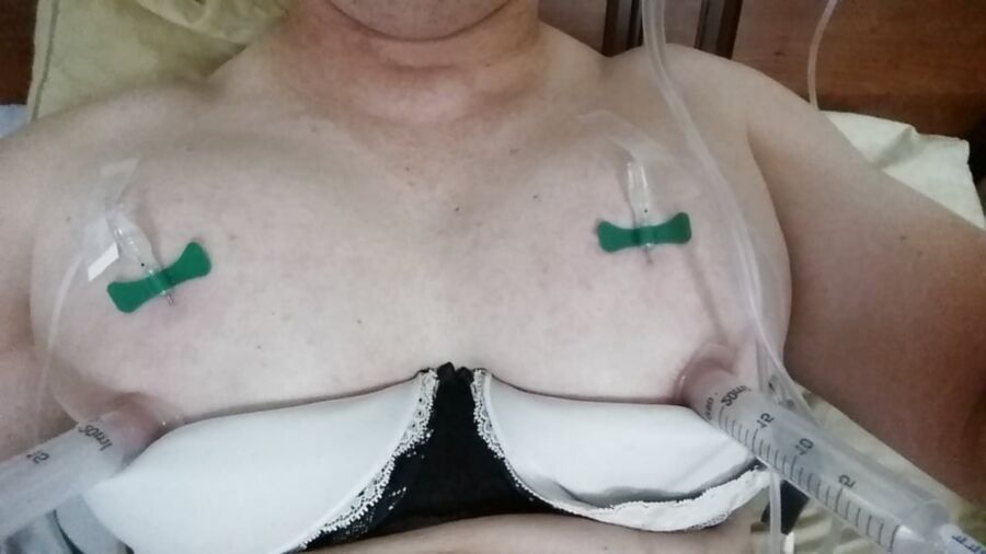 Saline inflation breast and balls.