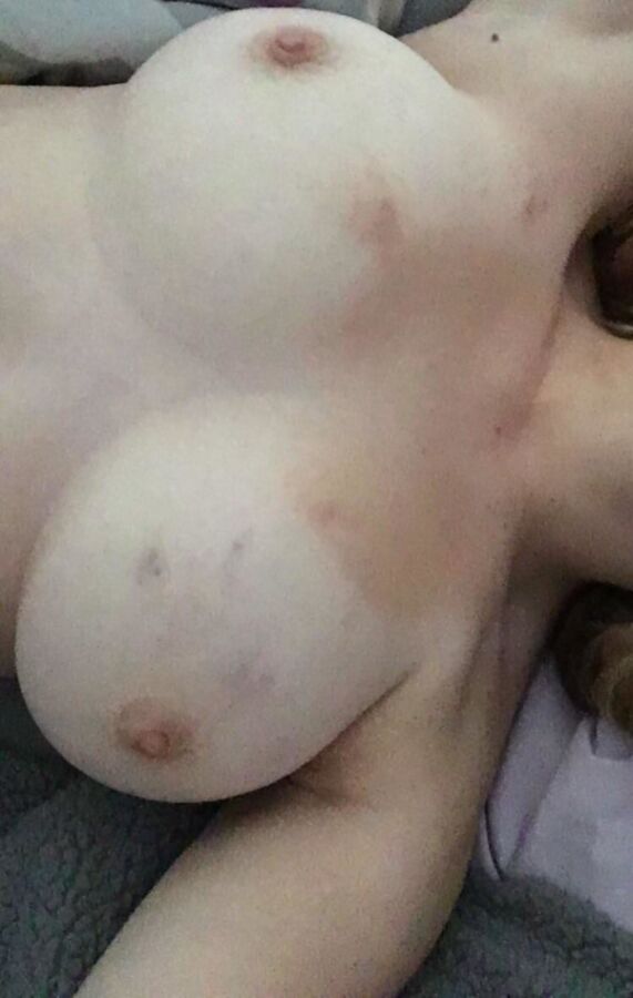 Free porn pics of Boyfriend Got A Liiiitle Too Rough Yesterday :D 1 of 1 pics