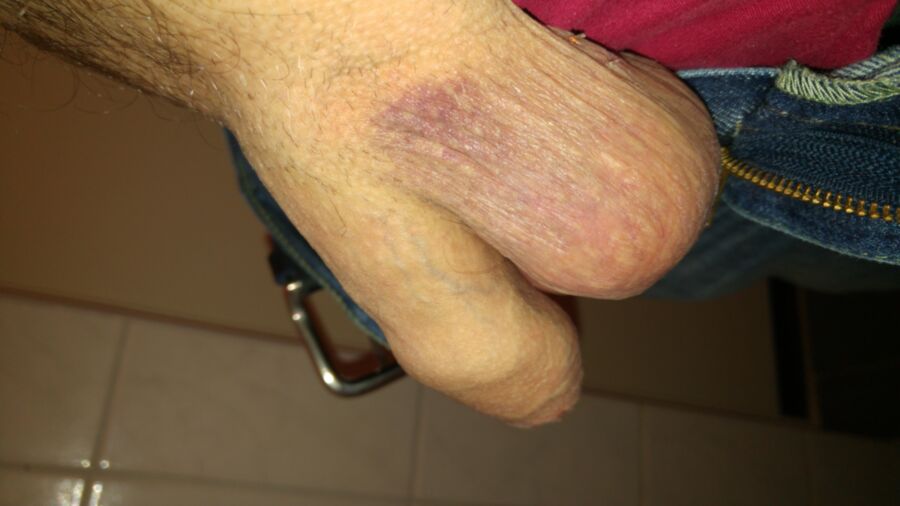 Free porn pics of Blue balls. Stiches and still horny. 1 of 3 pics