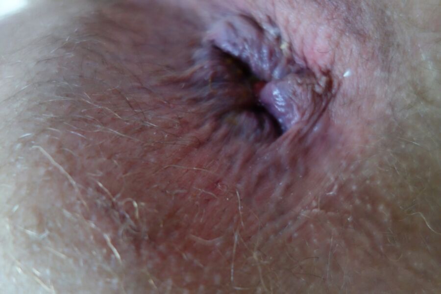 Free porn pics of Huge tunnel plug destroys my ass (incontinence) 9 of 10 pics