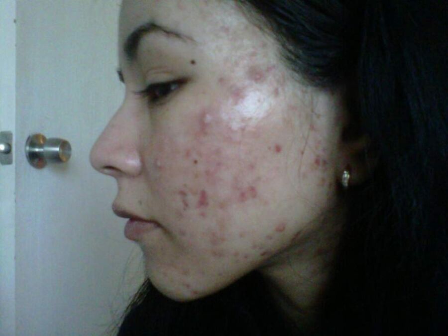 Free porn pics of Pimples - amateur faces covered with ugly acne spots 1 of 46 pics