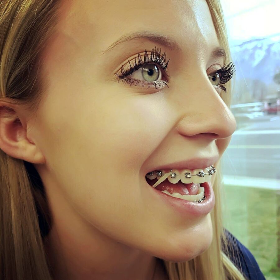 Free porn pics of Braces Images 23 of 65 pics