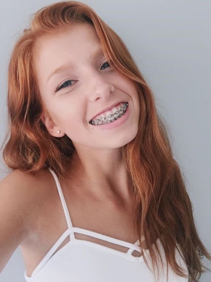 Free porn pics of Braces Images 20 of 65 pics