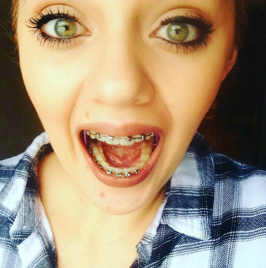 Free porn pics of Braces Images 16 of 65 pics