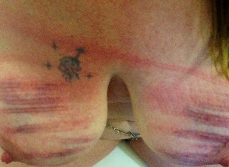 Abused and Bruised Tits 4 of 5 pics