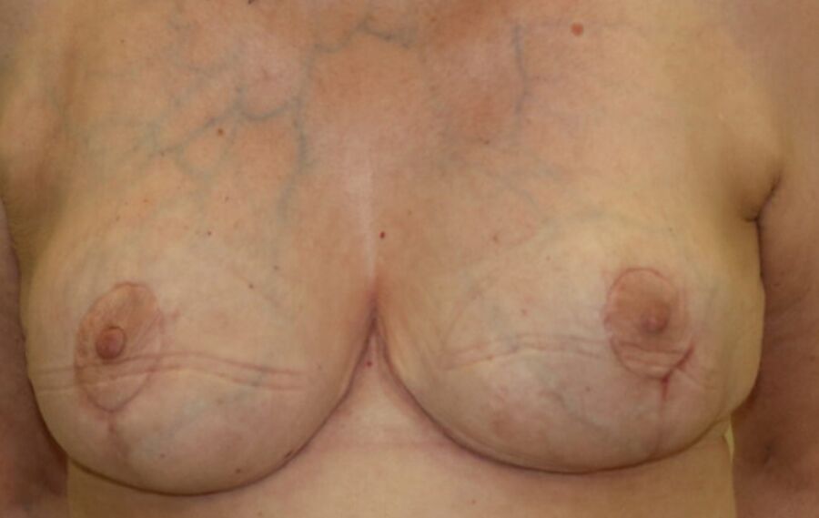 Repositioned stitched nipples. 24 of 35 pics