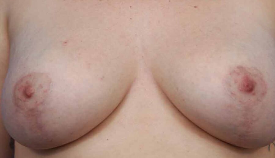 Repositioned stitched nipples. 17 of 35 pics