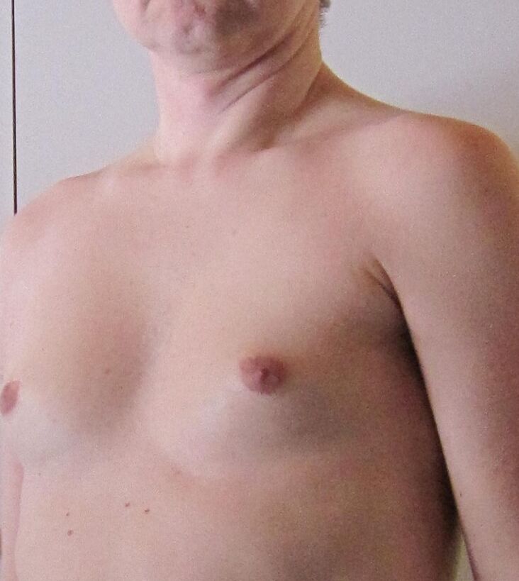 Sissyfaggot forced grow boobs - Before and after 1 of 14 pics