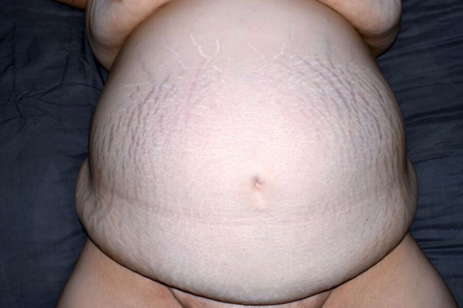 Abdomen With Stretchmarks 6 of 8 pics