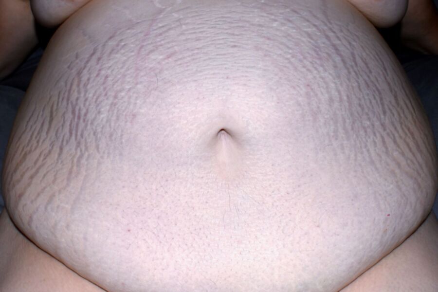 Abdomen With Stretchmarks 8 of 8 pics