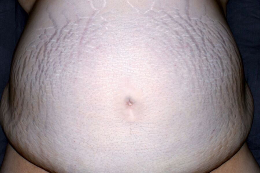 Abdomen With Stretchmarks 2 of 8 pics
