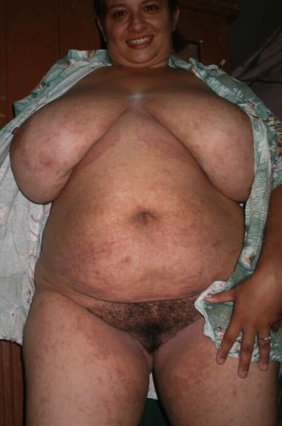 Fat argentinian poor with herpes 5 of 11 pics