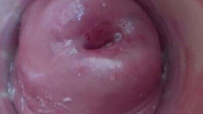 Cervix 1 of 51 pics