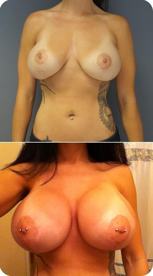 Shemale Breast Implants